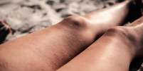 O suor e a umidade acabam piorando o atrito entre as pernas -  Foto: Shutterstock / Alto Astral