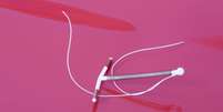 DIU &eacute; um m&eacute;todo contraceptivo pouco usado no Brasil -  Foto: Shutterstock / Alto Astral
