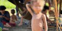 Criança yanomami com sinais de desnutrição  Foto: Associação Médicos da Floresta / BBC News Brasil