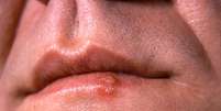 Manifestações do herpes começam com um inchaço e vermelhidão nos lábios, como se formasse uma bolha (Imagem: CDC/Dr. Hermann)  Foto: Canaltech
