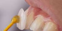 Lente de contato dental realmente desgasta os dentes? Entenda -  Foto: Shutterstock / Saúde em Dia