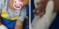 Bebê tem parte do dedo amputada após erro de enfermeira  Foto: Reprodução: Redes Sociais