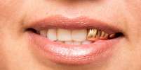 Dentes de ouro exigem cuidado e acompanhamento especializado -  Foto: Shutterstock / Alto Astral