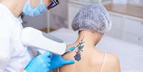 Procedimento estético pode remover completamente as tatuagens  Foto: ViktoriiaNovokhatska | Shutterstock / Portal EdiCase