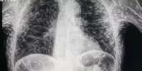 Radiografia de uma pessoa com cisticercose  Foto: Reprodução/ Twitter @vitorborin_