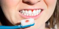 Gengiva sangrando após escovação é normal? Dentista responde -  Foto: Shutterstock / Saúde em Dia