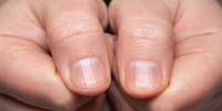 Sinal oculto nos dedos pode indicar câncer de pulmão; entenda   Foto: Shutterstock / Saúde em Dia