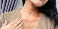 O envelhecimento do pescoço pode ser causado pela exposição ao sol -  Foto: Shutterstock / Alto Astral