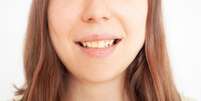 As manchas nos dentes são causadas por diversos fatores -  Foto: Shutterstock / Alto Astral