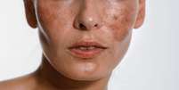 Entenda as manchas que podem surgir na sua pele -  Foto: Shutterstock / Alto Astral