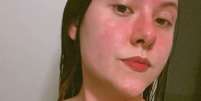 A influenciadora digital Flávia Leonel Santana tinha manchas avermelhadas na pele e pequenas bolhas  Foto: Arquivo pessoal / BBC News Brasil