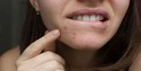 Vitamina B12 pode agravar acne; saiba quais alimentos têm o nutriente -  Foto: Shutterstock / Saúde em Dia