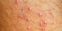 A foliculite é uma doença que atinge a raiz dos pelos da pele -  Foto: Shutterstock / Alto Astral