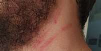 Gabriel Rossi ficou com marcas no pescoço após agressão  Foto: Arquivo pessoal/Maria Helena Barbosa