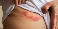 Saiba mitos e verdades sobre o herpes zóster -  Foto: Shutterstock / Alto Astral