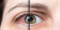 Sintomas da síndrome do olho seco pioram em julho; veja como prevenir -  Foto: Shutterstock / Saúde em Dia