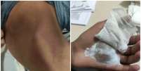 Segundo a conselheira tutelar, menino teve queimaduras de primeiro grau na m&atilde;o direita e queimaduras de segundo grau na m&atilde;o esquerda  Foto: Reprodu&ccedil;&atilde;o/EPTV
