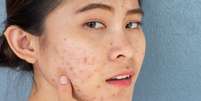 Descubra 4 maus hábitos do dia a dia que causam danos à pele -  Foto: Shutterstock / Saúde em Dia