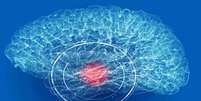 Alerta: dor de cabeça sem melhora pode indicar aneurisma cerebral -  Foto: Shutterstock / Saúde em Dia