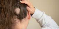 A alopecia pode estar associada a estresse e falta de vitaminas -  Foto: Shutterstock / Alto Astral