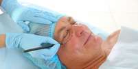 Facelift: cirurgia promove rejuvenescimento facial -  Foto: Shutterstock / Saúde em Dia