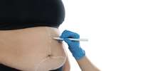 Bariátrica: qual tipo de cirurgia escolher para evitar o reganho de peso? -  Foto: Shutterstock / Saúde em Dia
