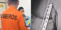 O adolescente foi socorrido pelo Corpo de Bombeiros e precisou colocar um pino no braço  Foto: Reprodução/Instagram/@moabbrasil