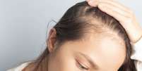 A calv&iacute;cie feminina &eacute; uma condi&ccedil;&atilde;o considerada rara -  Foto: Shutterstock / Alto Astral
