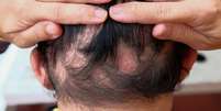 A alopecia areata &eacute; uma doen&ccedil;a que provoca a queda severa de cabelo -  Foto: Shutterstock / Alto Astral