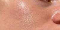 Pele oleosa? Dermatologista explica como deve ser rotina de skincare -  Foto: Shutterstock / Saúde em Dia