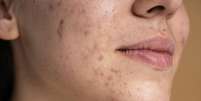 A acne é causada pelo bloqueio ou inflamação dos folículos pilosebáceos (Imagem: Freepik/Domínio Público)  Foto: Canaltech