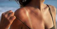 Veja quais são as orientações da dermatologista para cuidar da pele queimada por sol  Foto: Freepik/Divulgação / Boa Forma