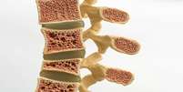 Osteoporose pode atingir a coluna: conheça os sinais e como tratar  Foto: Shutterstock / Saúde em Dia