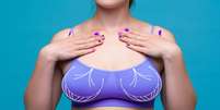Melhora a silhueta e a postura: conheça os benefícios da mamoplastia redutora  Foto: Shutterstock / Saúde em Dia