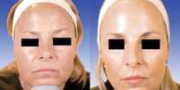 Gêmea que não aplicou botox (à esquerda) versus gêmea que aplicou (à direita) Foto: Dermatologic Surgery