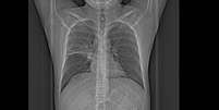 Exames de raio-x, tomografia e biópsia são utilizados para diagnosticar a doença  Foto: Reprodução / BBC News Brasil