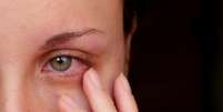 Dengue pode se manifestar nos olhos; conheça os sintomas  Foto: Shutterstock / Saúde em Dia