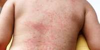 O aparecimento de manchas vermelhas na pele é um sintoma associado à febre hemorrágica da dengue  Foto: Getty Images / BBC News Brasil