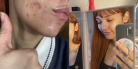 Jovem usa ácido no rosto e pele apresenta piora  Foto: Reprodução Twitter / Reprodução Twitter