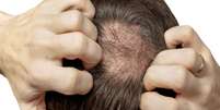 Calv&iacute;cie precoce: vejas as causas de perda de cabelo entre os jovens  Foto: Shutterstock / Sa&uacute;de em Dia