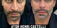 Henri Castelli realiza harmonização facial; confira o resultado  Foto: @avallonecamila / @avallonecamila