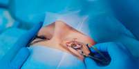 Miopia, hipermetropia e astigmatismo: cirurgia refrativa pode corrigir visão  Foto: Shutterstock / Saúde em Dia