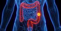 Aumento proporcional de casos de tumor no intestino entre mais jovens chamou a atenção de cientistas  Foto: Getty Images / BBC News Brasil