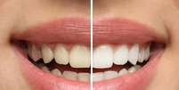 Clareamento dental deve ser feito por dentista  Foto: New Africa | Shutterstock / Portal EdiCase
