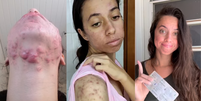 Brasileira usa redes sociais para mostrar sua batalha contra a acne severa  Foto: Reprodução / Instagram / @_dudaalemes / Reprodução / Instagram / @_dudaalemes
