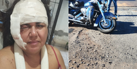 Empresária leva mais de 60 pontos no rosto e quebra braço em acidente de moto   Foto: Arquivo Pessoal 