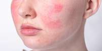Estado emocional pode causar manchas vermelhas na pele; entenda  Foto: Shutterstock / Saúde em Dia