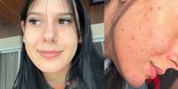 Ana Castela mostra antes e depois de tratamento para a acne e impressiona seguidores. Veja!.  Foto: Instagram / Purepeople