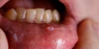 Lesões que não cicatrizam: conheça os sintomas do câncer de boca  Foto: Shutterstock / Saúde em Dia