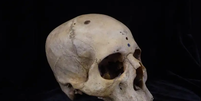 Crânio do homem egípcio com lesão causada por tumor  Foto: Tondini/Isidro/Camarós/Divulgação